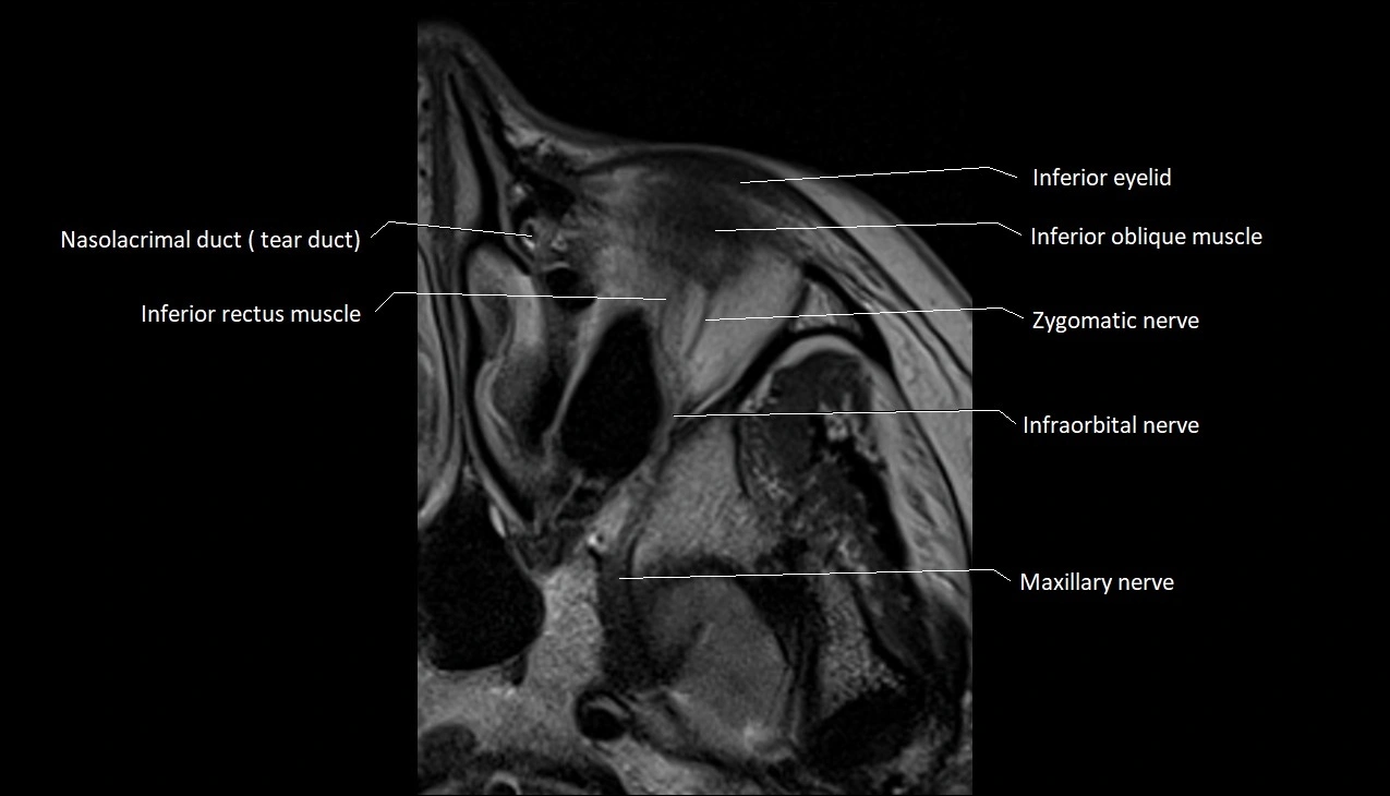 MRI Orbit axial cross sectional anatomy image 3.webp